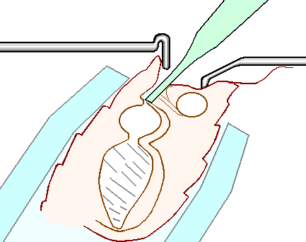 Conventional approach to instrumental insemination